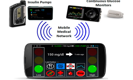 Crean el páncreas artificial para mejorar el tratamiento de la diabetes tipo 1
